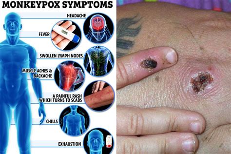 The 8 symptoms of monkeypox you need to know