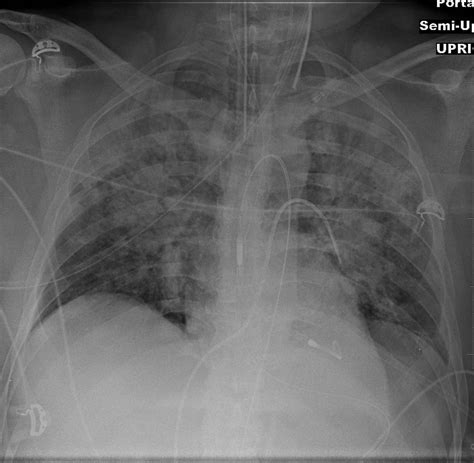 CXR-Impella | MD Nexus