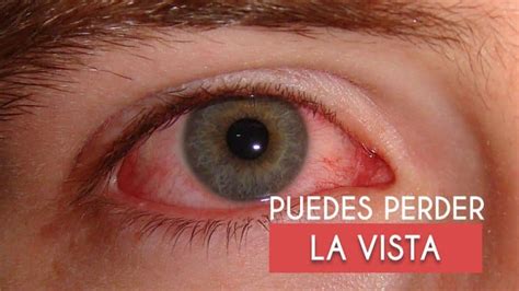 21 Enfermedades de los ojos más comunes【Síntomas y Tratamiento】