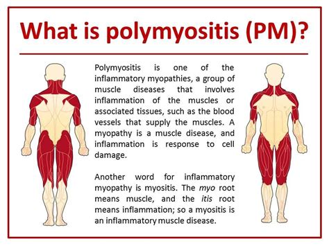 MEDICAL SCHOOL: polymyositis,what to know? | Polymyositis, Muscle ...