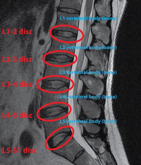 Healthcare Extreme How To Read An MRI Lumbar Spine In 8 Easy Steps