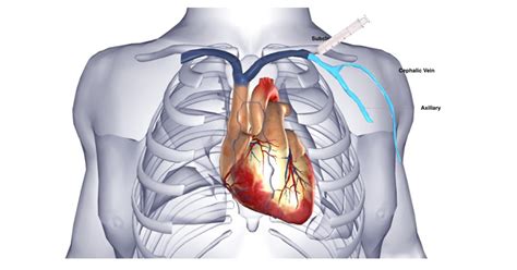 AICD Implantation - Dr Bhupendra