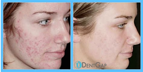 Laser Scar Removal: Facts, Cost, Does it work?