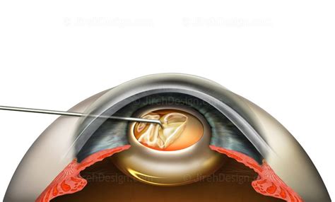 Removing capsulorhexis tissue - #SUCA0075 - Stock eye images