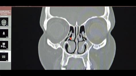 When to Operate for FESS in Chronic Bilateral Pansinusitis with Neo ...