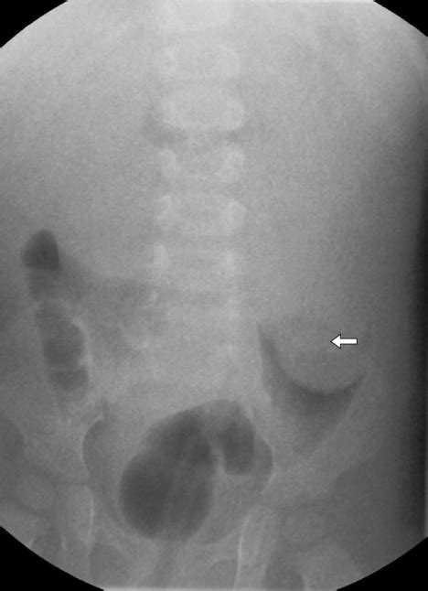 Intussusception | Radiology Key