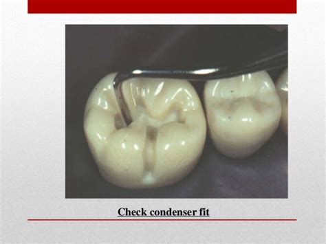 procedure for amalgam restoration