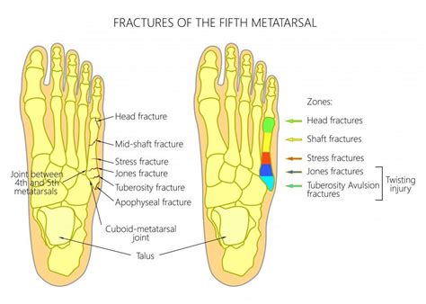 Tuberosity Of 5th Metatarsal Pain