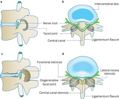 Lumbar spinal stenosis | The BMJ