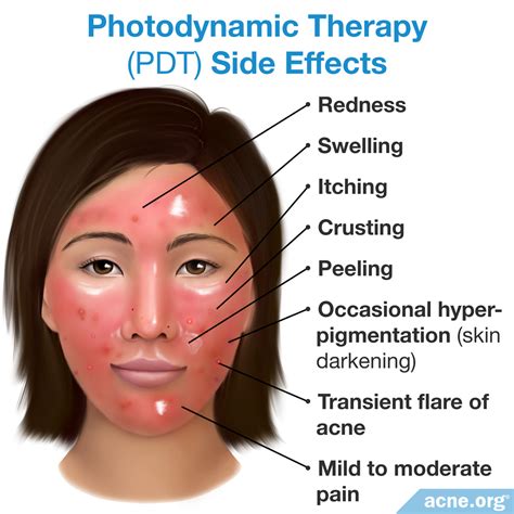 Photodynamic Therapy - PDT - Acne.org