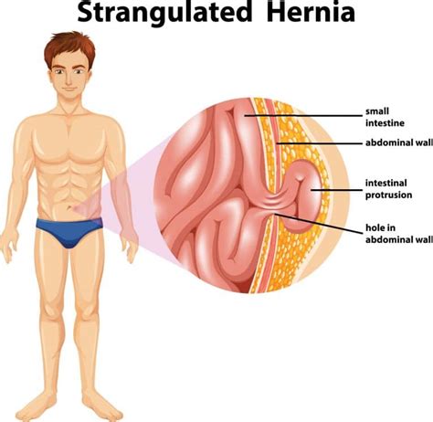 Oblique Pain: Muscle Strain Or Sports Hernia? Determine Your Injury In Seconds.