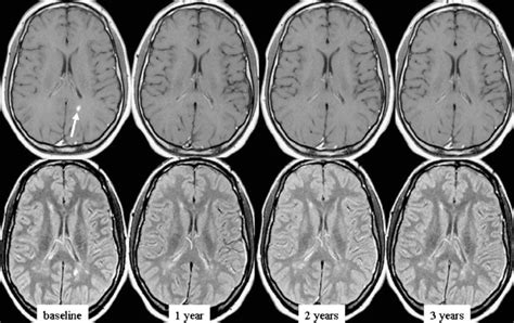 Ms Brain Mri With Contrast