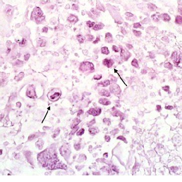 In situ hybridization for HSV1 highlight the infected cell (arrow ...