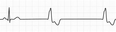 Ventricular Rhythm