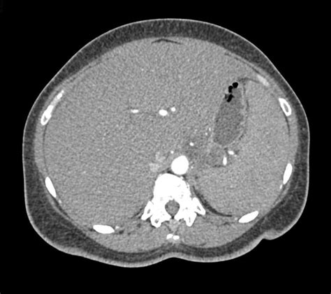 Budd-Chiari Syndrome with Perfusion Changes in the Liver - Liver Case Studies - CTisus CT Scanning