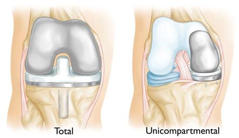 Unicompartmental (Partial) Knee Replacement - OrthoInfo - AAOS