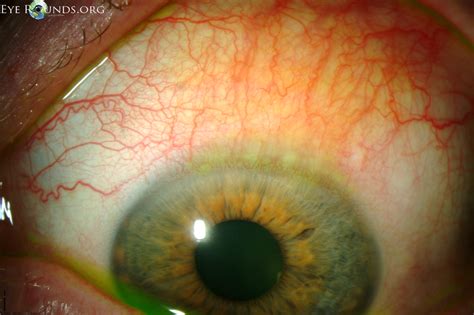 Atlas Entry - Superior limbic keratoconjunctivitis (SLK)