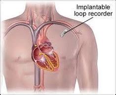 Implantable Loop Recorder (ILR) - Prof Dr Dennis Lau - Cardiologist in ...