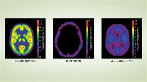 What is the Difference Between a Coma and Brain Death? | LifeSource