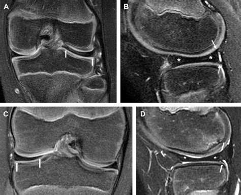 Discoid Meniscus in the Pediatric Population: | Radiology Key