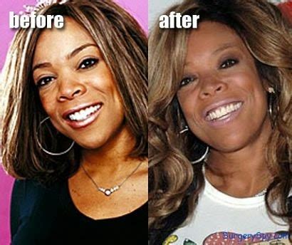 Wendy Williams Plastic Surgery Nose Job, Breast Implants Before and After Pictures