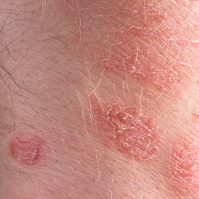 Difference Between Eczema and Psoriasis | Med-Health.net