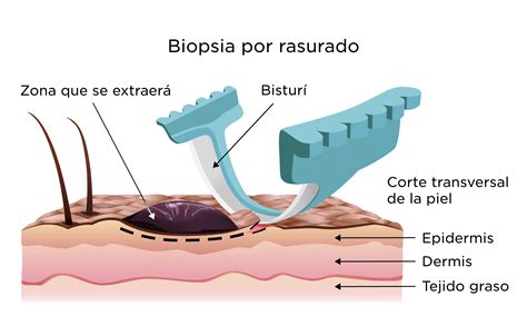 Biopsia de piel | My Doctor Online