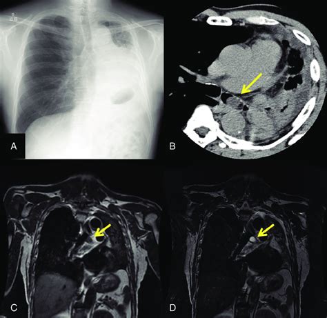 (A) The chest radiography findings led to a diagnosis of obstructive... | Download Scientific ...