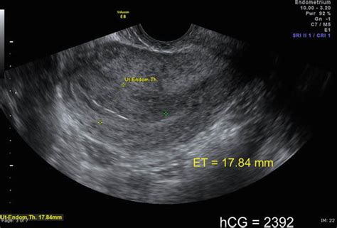 Ectopic Pregnancy: Pregnancy of Unknown Location (PUL) | Radiology Key