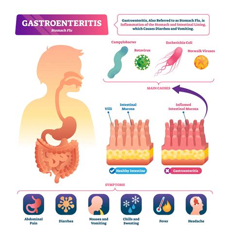 Gastroenteritis - Causes, Symptoms, and Treatments | Medanta