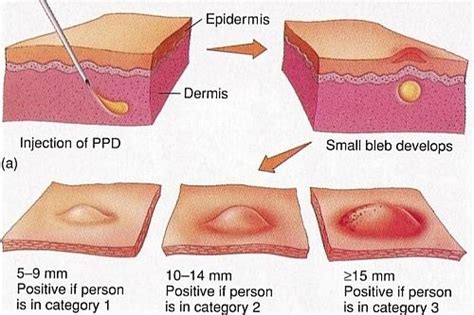 Tuberculin Skin Test (Positive Mantoux Test) Result, Reading and ...