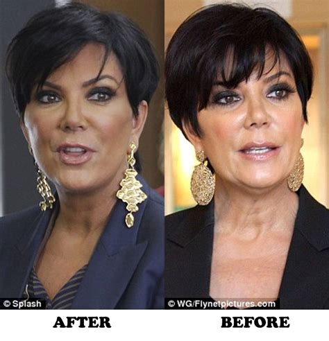 Kris Jenner Plastic Surgery Before and After Botox and new Facelift ...