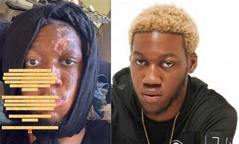 Rapper OG Maco Shares Graphic Video Of Battle With Flesh Eating Disease ...