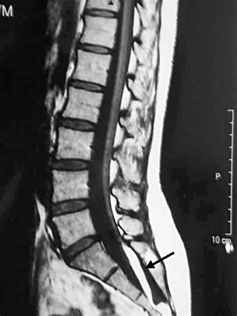 Adult tethered cord syndrome presenting with refractory diarrhoea ...