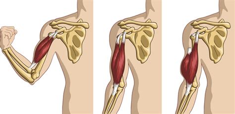 Bicep Tendon Tears and Tendonitis - Austin Chen MD