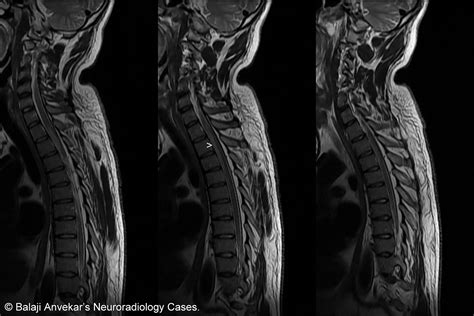 The Spinal Cord: Mri Of The Spinal Cord