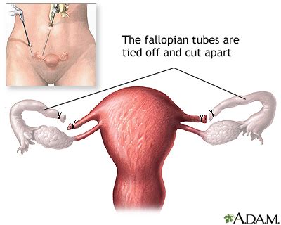 Fallopian Tube Surgery