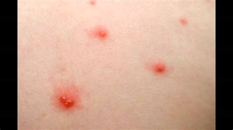 Chicken Pox SYMPTOMS and FACTS - YouTube