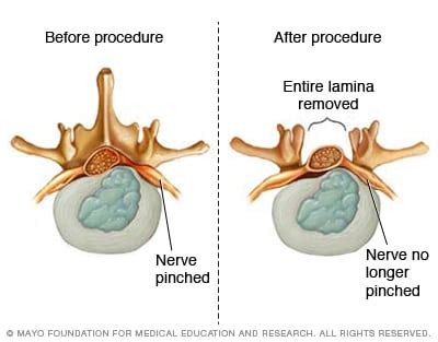 Lumbar Laminectomy | Sierra Neurosurgery Group