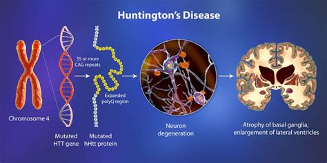 What is Huntington's Disease - HD, Huntingtin, Huntington's Doctor