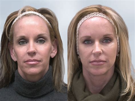 Sculptra Before and After 3 | Robinson FPS