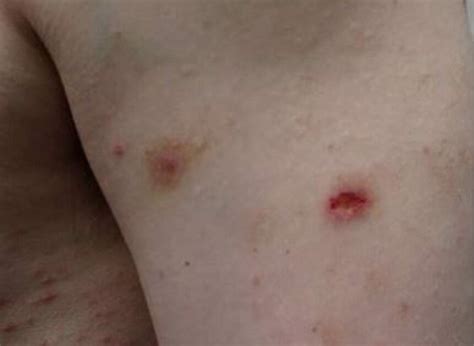 Clinical Challenge: Pruritic, Erythematous Papules and Nodules - MPR