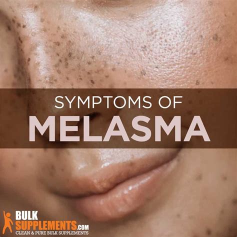 Melasma: Symptoms, Causes, Diagnosis And Treatments, 52% OFF