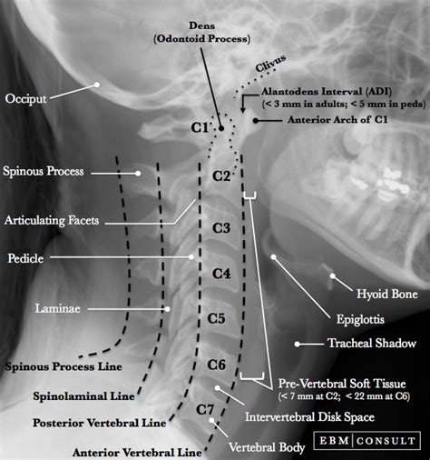 Wackenheim Line on Radiographic Image