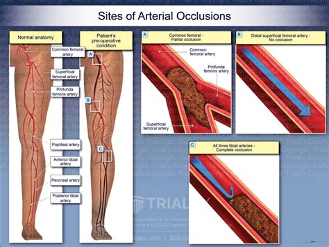 Sites of Arterial Occlusions - Trial Exhibits Inc.