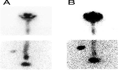 Radionuclide Shuntogram Demonstrating Migration of Distal Ve... : Clinical Nuclear Medicine