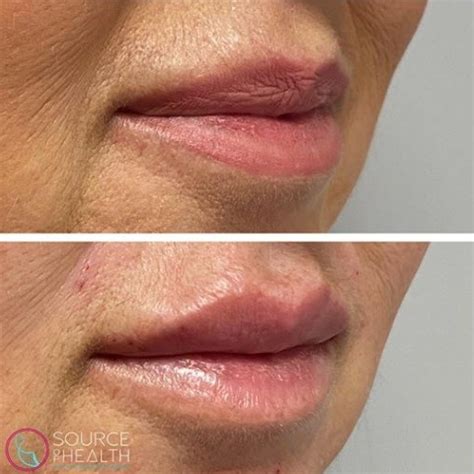 Restylane Defyne For Lips – Keith Wiley