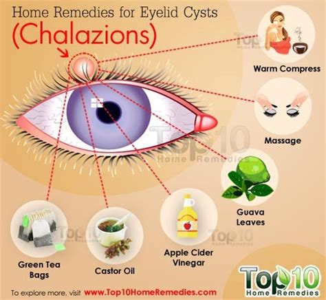 Home Remedies for Eyelid Cysts (Chalazions) | Top 10 Home Remedies