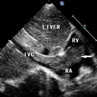 Echocardiography showing an isoechoic to hyperechoic mass (arrow ...