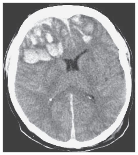 Hyperosmolar Therapy for Raised Intracranial Pressure | New England Journal of Medicine